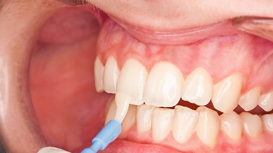 Barnizado de los dientes con un cepillo