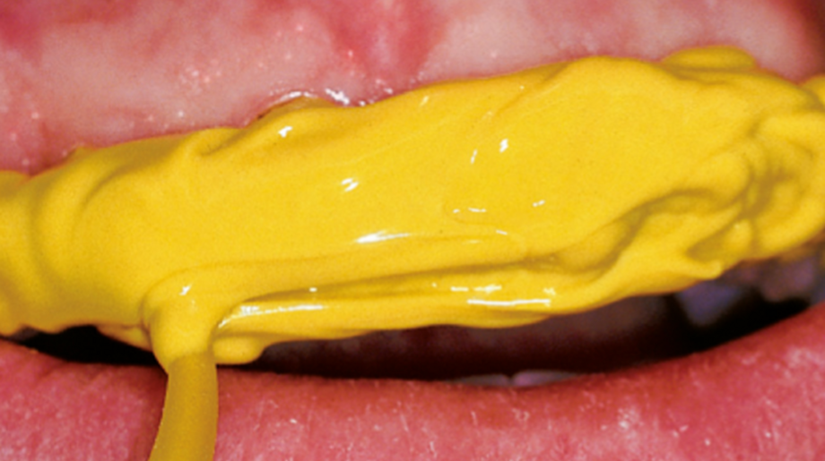 Material amarillo en los dientes, no escurre